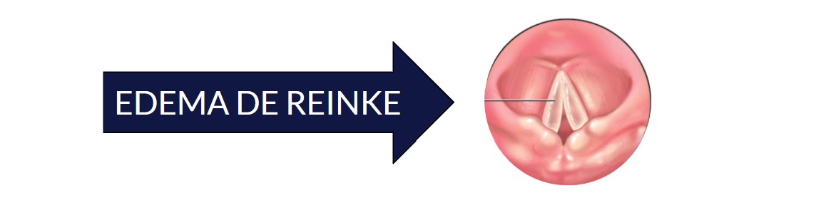 mivesuav's tweet photo. El edema de Reinke es un engrosamiento que afecta toda la extensión de las cuerdas vocales, causado por la acumulación de material inflamatorio en el espacio de Reinke. Es una lesión bilateral, asimétrica, de tamaño variable, que altera significativamente la calidad vocal. https://t.co/f0c2VbzgPb