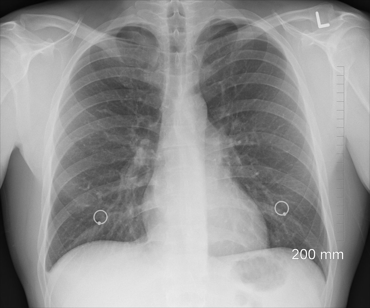 NIHR Cambridge Biomedical Research Centre (@cambridgebrc) on Twitter photo A study funded by the <a href="/myrovlytis/">Myrovlytis Trust</a> which we supported found up to 1 in 3,000 people could be carrying a faulty gene that significantly increases their risk of a punctured lung, see bit.ly/42nODan for more <a href="/uk_biobank/">UK Biobank</a> <a href="/CUH_NHS/">Cambridge University Hospitals NHS</a> <a href="/Cambridge_Uni/">Cambridge University</a> <a href="/East_Genomics/">NHS East Genomics</a> <a href="/GenomicsEngland/">Genomics England</a> A study funded by the <a href="/myrovlytis/">Myrovlytis Trust</a> which we supported found up to 1 in 3,000 people could be carrying a faulty gene that significantly increases their risk of a punctured lung, see bit.ly/42nODan for more <a href="/uk_biobank/">UK Biobank</a> <a href="/CUH_NHS/">Cambridge University Hospitals NHS</a> <a href="/Cambridge_Uni/">Cambridge University</a> <a href="/East_Genomics/">NHS East Genomics</a> <a href="/GenomicsEngland/">Genomics England</a>