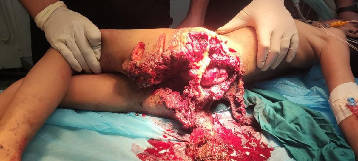 ⚠️⚠️Sensitive Content ⚠️⚠️

🚨A 9-year-old child died yesterday there were no supplies to save him.

This is what Israeli incendiary missiles do to children in Gaza: they burn their bodies, shred their limbs, and leave injuries too severe to treat under a collapsed healthcare