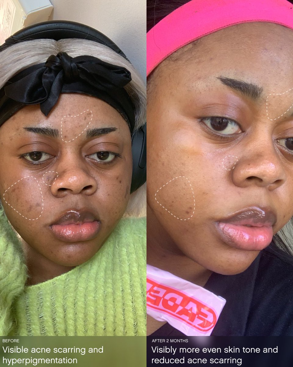 Real results, real people.  

After 2 months of using Faded Unscented, she saw improvements in the texture and appearance of her skin. 

You can now get up to 20% off Faded at Sephora online &amp; in-store 

(IG: im_joylove)