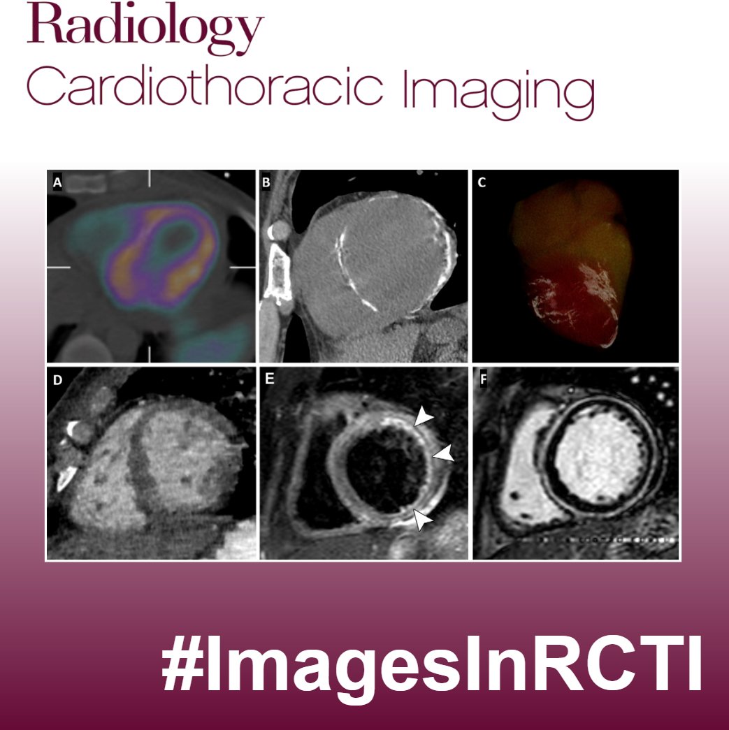 Francisco Calle (@fcallemd) on Twitter photo 🚨🫀
A 38-year-old male patient with a history of T-cell lymphoma and stem cell transplant, presents with decompensated heart failure, elevated troponin and ventricular tachycardia.
What are the findings? What is the diagnosis?
#InTrainingRCTI #ImagesInRCTI
<a href="/RadiologyCTI/">Radiology: Cardiothoracic Imaging</a> 🚨🫀
A 38-year-old male patient with a history of T-cell lymphoma and stem cell transplant, presents with decompensated heart failure, elevated troponin and ventricular tachycardia.
What are the findings? What is the diagnosis?
#InTrainingRCTI #ImagesInRCTI
<a href="/RadiologyCTI/">Radiology: Cardiothoracic Imaging</a>
