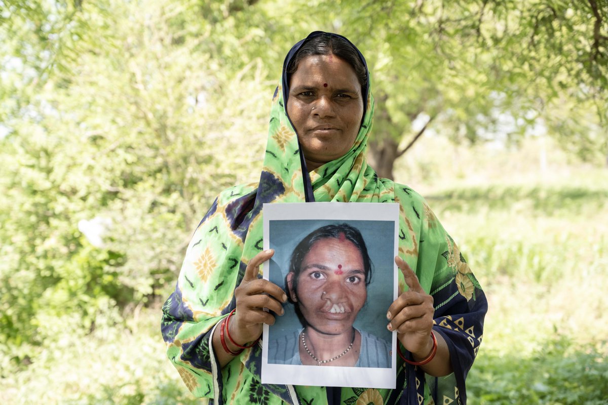 Smiletrain's tweet photo. Meet Surekha from India! 🇮🇳 Born with a cleft, her life changed after receiving a free surgery from Smile Train's partner. Now, she shares a bright, confident smile, forever grateful for the support that made it possible. 

#SmileTrain #clefts #cleftcare https://t.co/ZlfKcCaqf9
