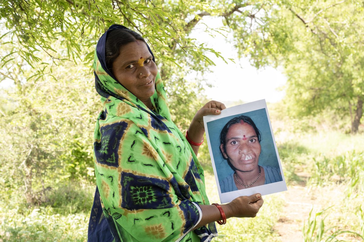 Smiletrain's tweet photo. Meet Surekha from India! 🇮🇳 Born with a cleft, her life changed after receiving a free surgery from Smile Train's partner. Now, she shares a bright, confident smile, forever grateful for the support that made it possible. 

#SmileTrain #clefts #cleftcare https://t.co/ZlfKcCaqf9