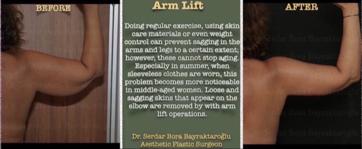Clinicsbbintl's tweet photo. ARM LIFT 

Get a thighter look on your sagging arms over time with arm lift surgery

#clinicsbb #clinicsbbinternational #aestheticsurgery #plasticsurgery #plasticsurgeon #serdarborabayraktaroglu #beforeafter #armlift #aesthetic https://t.co/CzNzkUVdcO