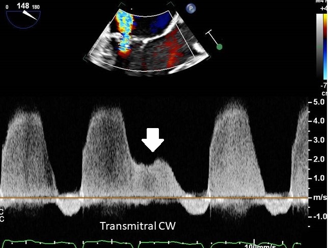 A patient for TEE prior to cardioversion. CW interrogation across the mitral valve in the long axis view. What is the low velocity signal indicated by the arrow?