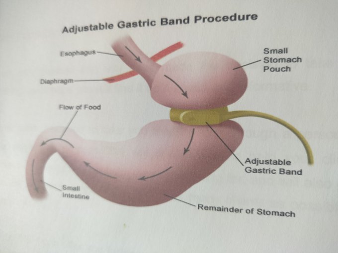 Are you looking to lose weight for the summer? A virtual gastric band may be the answer stephenmcmurray.com/virtual-gastri… #Edinburgh #VGB #VirtualGastricBand #GastricBand #Obseity #Diabetes #Hypnosis #Hypnotherapy