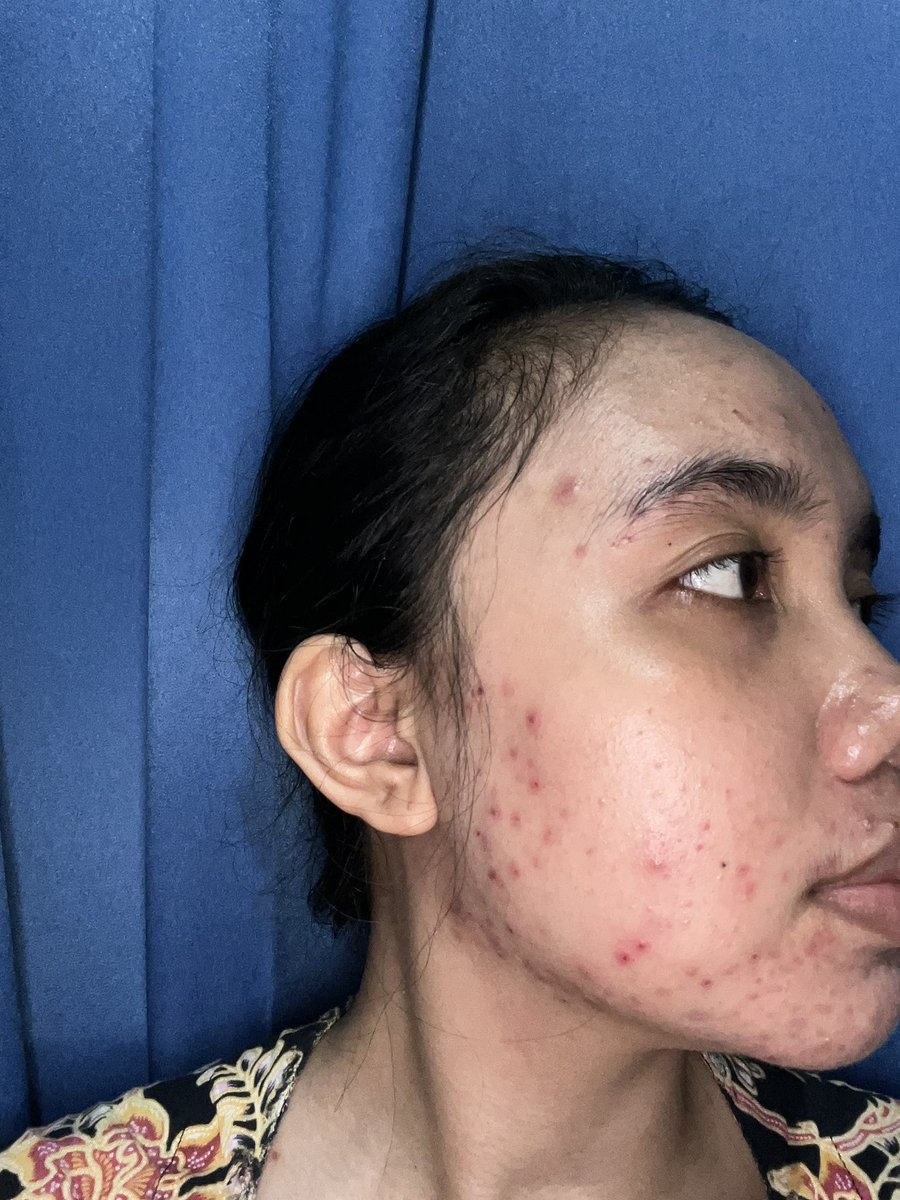 Fluorate's tweet image. Acne fighter journey 🤺

   June 2024                          March 2025