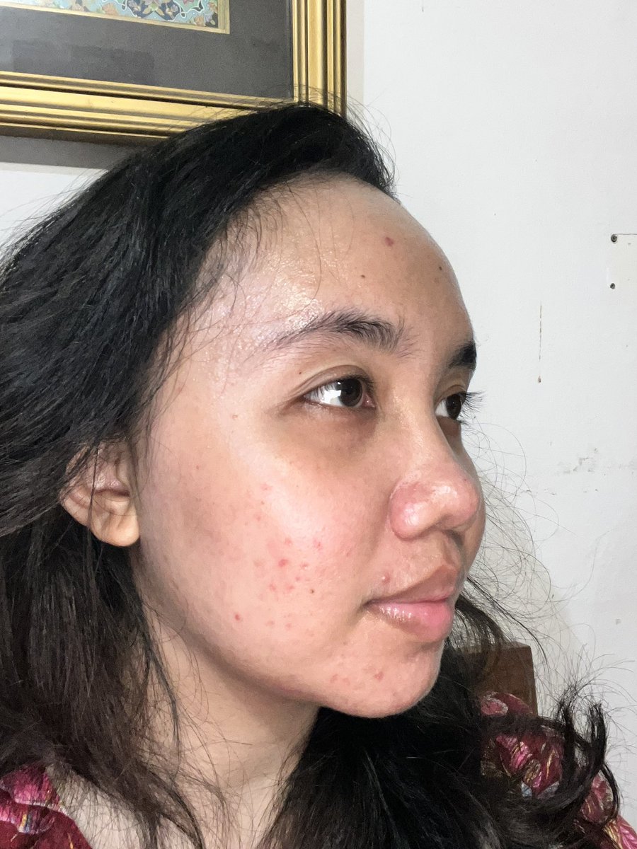 Fluorate's tweet image. Acne fighter journey 🤺

   June 2024                          March 2025