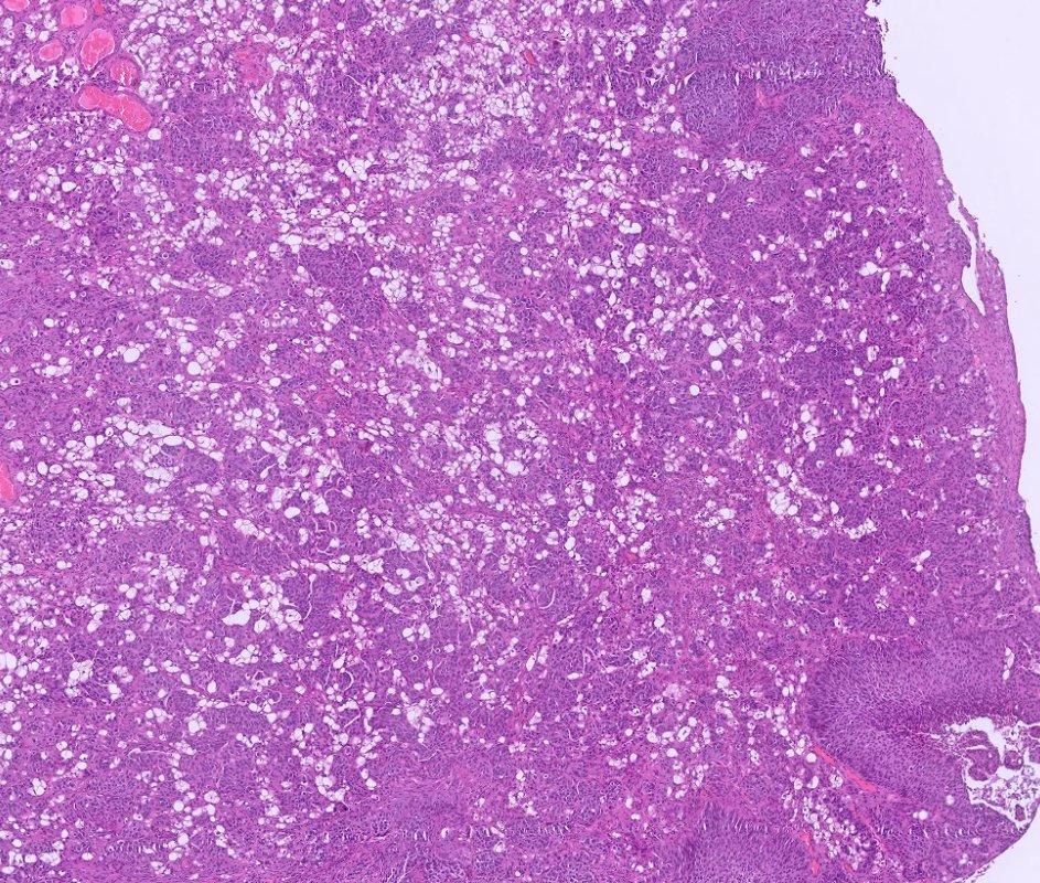 MdMufy's tweet photo. High-grade papillary urothelial carcinoma with lipoblastic differentiation. https://t.co/qADbPt4qeQ