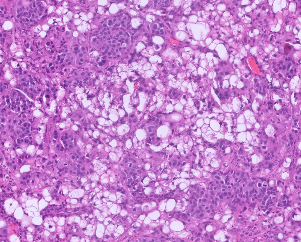 MdMufy's tweet photo. High-grade papillary urothelial carcinoma with lipoblastic differentiation. https://t.co/qADbPt4qeQ