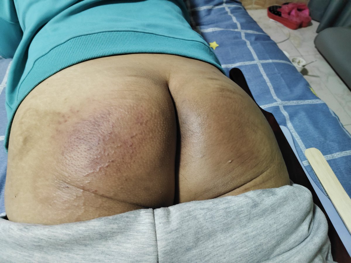 小更一下，板子不显伤，但是真疼啊
#MMSP