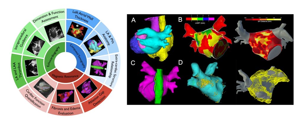 JICE (@jice_ep) on Twitter photo 🚨Latest #FreeRead Article in
<a href="/JICE_EP/">JICE</a>
The Use of Cardiac Imaging in Patients Undergoing Atrial Fibrillation Ablation
🧐📖rdcu.be/egU6Z
by <a href="/filiberti_gaia/">Gaia Filiberti, MD</a>, Giulia Antonelli, <a href="/DrFalasconi/">Giulio Falasconi, MD</a>, <a href="/AleVillaschi/">Alessandro Villaschi</a>, <a href="/Figliozzis/">Stefano Figliozzi</a>, <a href="/MartinaMariaRu1/">Martina Maria Ruffo</a>, Antonio Taormina, 🚨Latest #FreeRead Article in
<a href="/JICE_EP/">JICE</a>
The Use of Cardiac Imaging in Patients Undergoing Atrial Fibrillation Ablation
🧐📖rdcu.be/egU6Z
by <a href="/filiberti_gaia/">Gaia Filiberti, MD</a>, Giulia Antonelli, <a href="/DrFalasconi/">Giulio Falasconi, MD</a>, <a href="/AleVillaschi/">Alessandro Villaschi</a>, <a href="/Figliozzis/">Stefano Figliozzi</a>, <a href="/MartinaMariaRu1/">Martina Maria Ruffo</a>, Antonio Taormina,