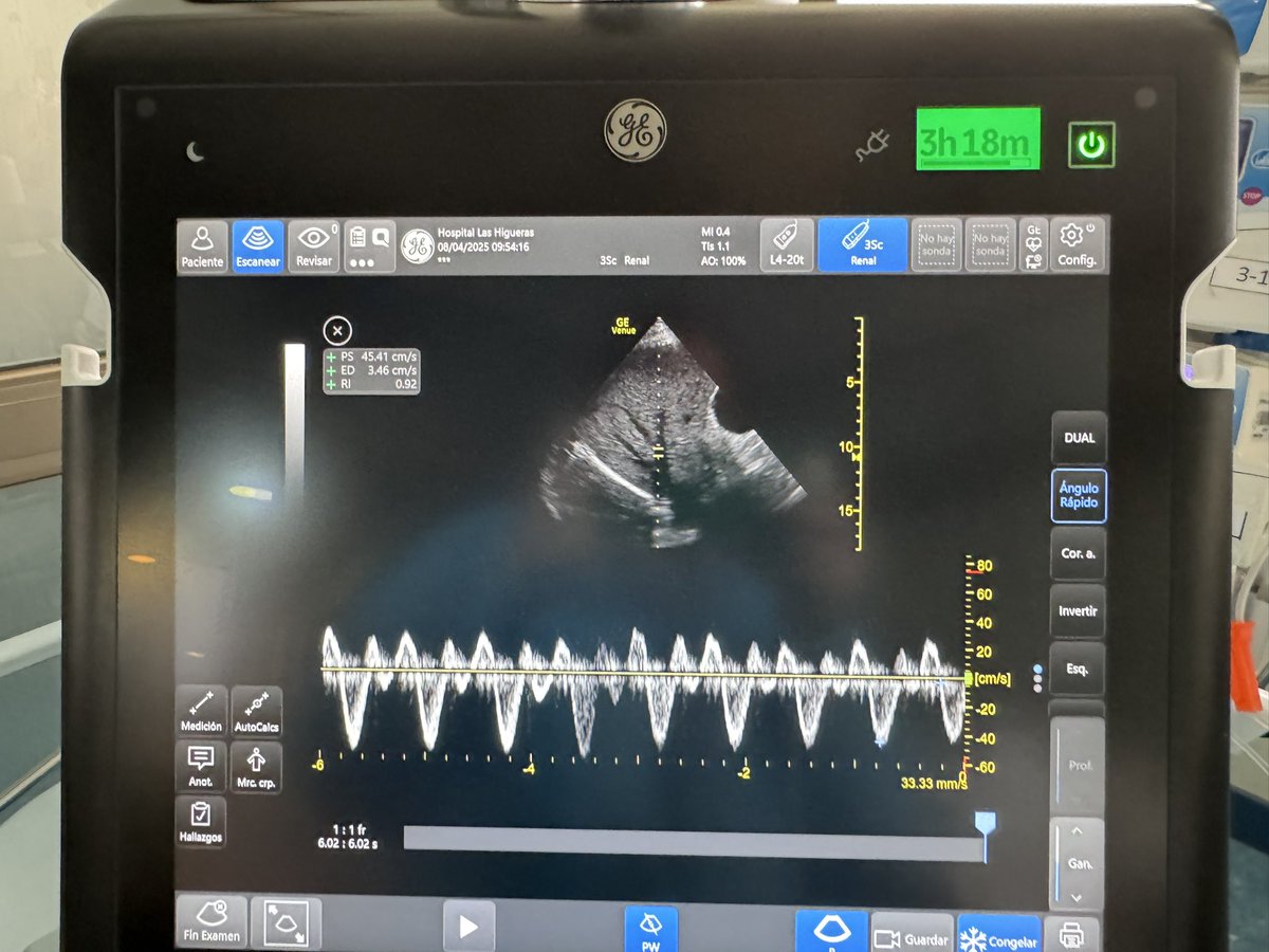 Uso de VExUS en Trasplante Renal