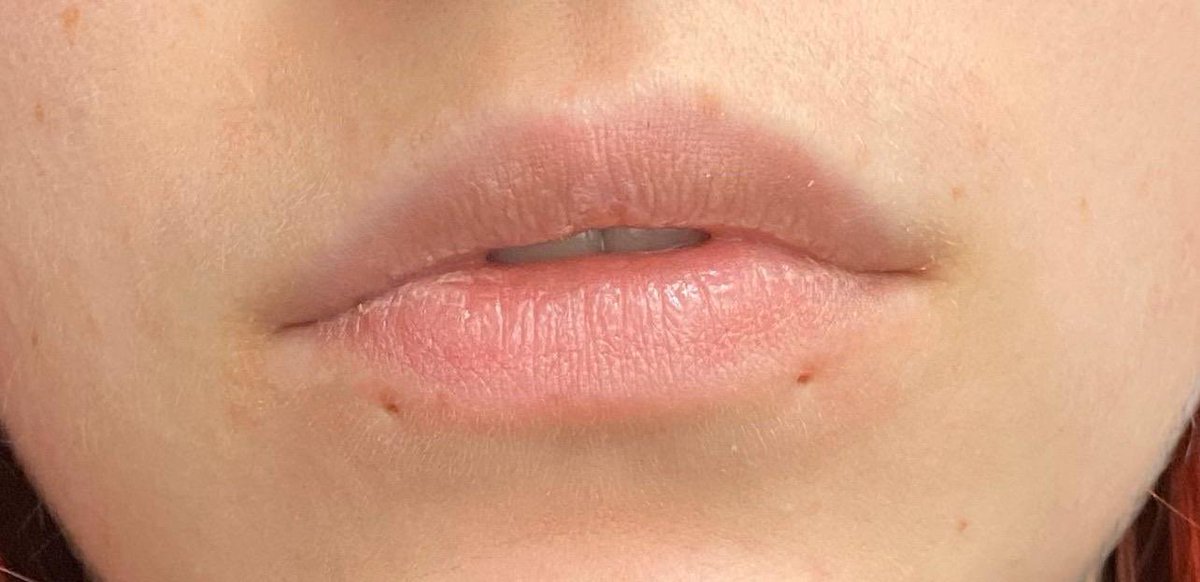 I love when people get lip piercing then take them out and are left with the holes