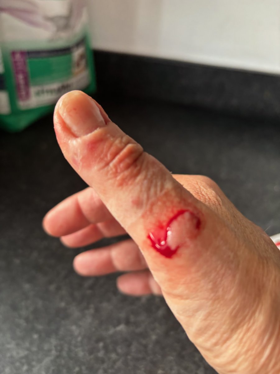 deekybloke's tweet image. @asda you may want to take these glasses off the shelf. Look at the damage an unbroken one did to my wife’s hand whilst washing.  No breaks or chips, the rims are too sharp and dangerous!!!