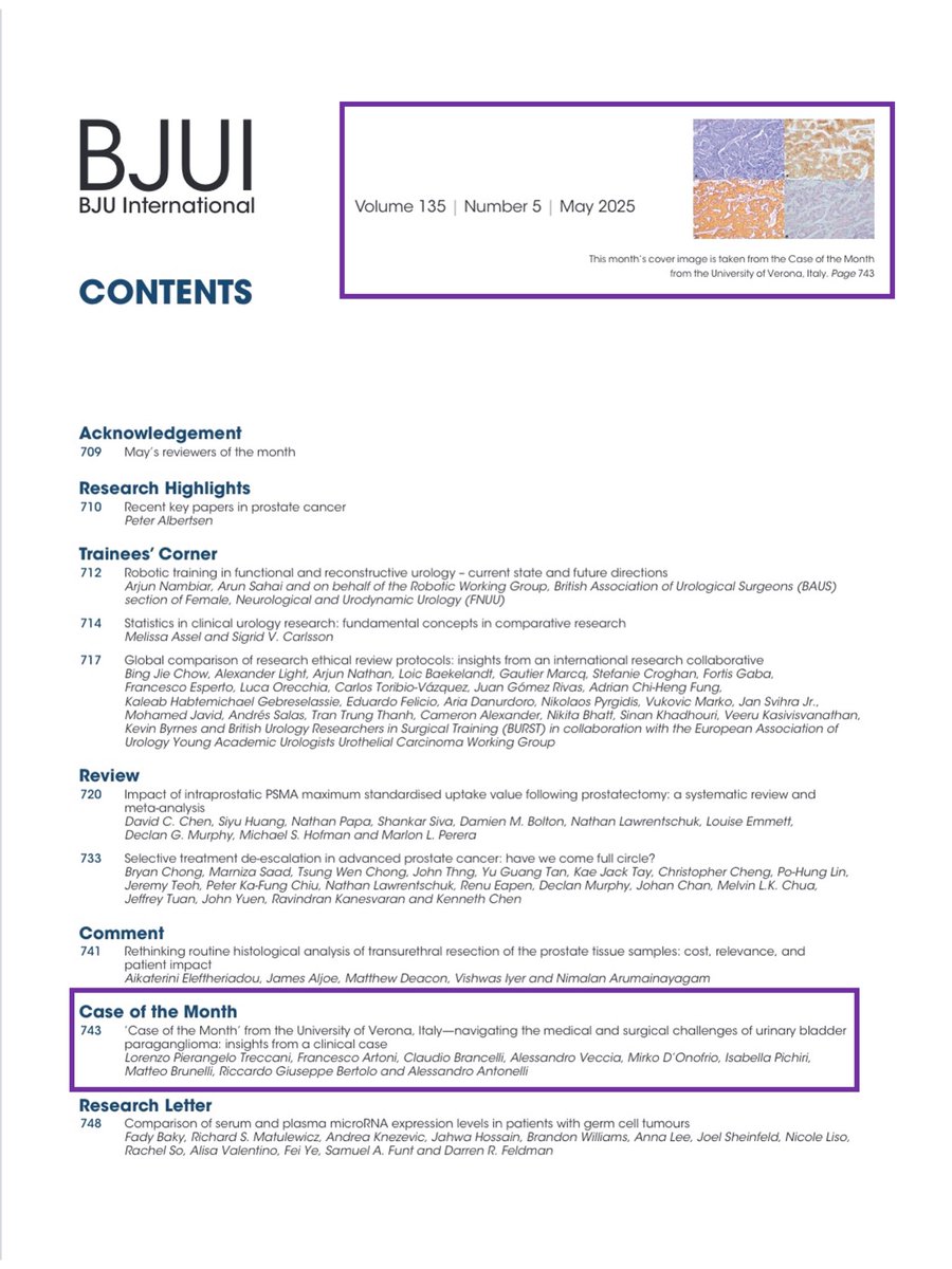 ๐๐๐๐๐๐ง๐๐ค ๐ฝ๐๐ง๐ฉ๐ค๐ก๐ค MD PhD (@ricbertolo) on Twitter photo We made the <a href="/BJUIjournal/">BJU International</a> cover!
Our #casereport on urinary #bladder #paraganglioma was selected as the front cover for the May 2025 issue of the British Journal of Urology International โ a proud moment for the #team at the University of Verona!
A challenging case highlighting We made the <a href="/BJUIjournal/">BJU International</a> cover!
Our #casereport on urinary #bladder #paraganglioma was selected as the front cover for the May 2025 issue of the British Journal of Urology International โ a proud moment for the #team at the University of Verona!
A challenging case highlighting