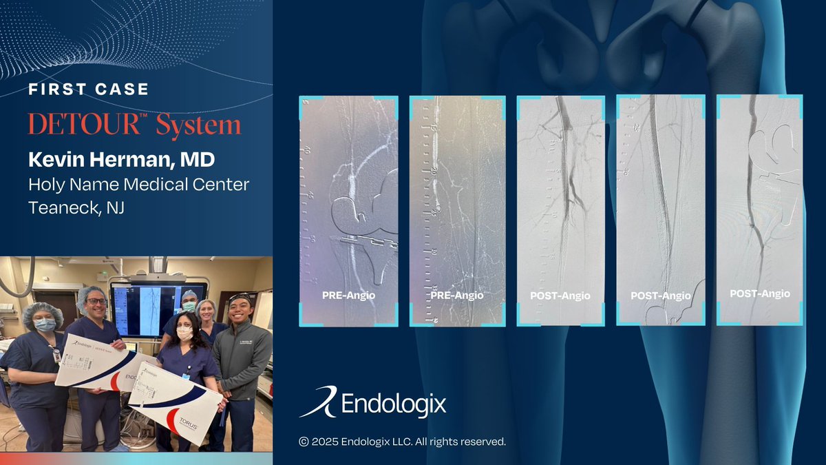 We are thrilled to celebrate the first #PTAB case with the #DETOURSystem for Dr. Kevin Herman and team. It's always a great day to find out that another #SFA patient low on options has benefited from this novel therapy. Thank you for leading the way and introducing this