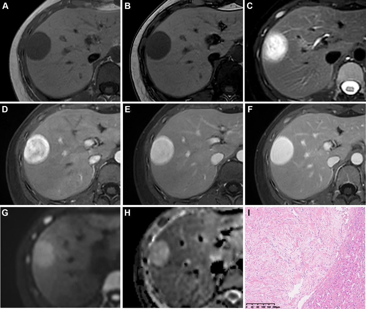 Check out this interesting Images in Radiology case of an incidentally detected soft tissue lesion in the liver. bit.ly/42Brcvw