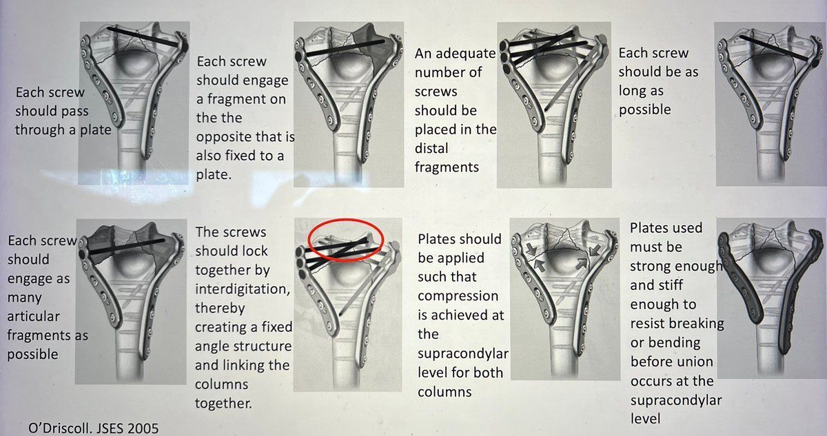 MoAImam's tweet photo. The 8 commandments by O’Driscoll for fixing the distal humeral fractures! https://t.co/ZvcHj9tNej