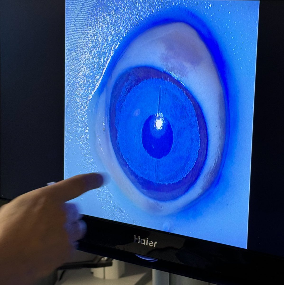 FLAAKAcademy's tweet photo. ✅ Safe, regulated & realistic: the #FLAAK technique leads #eyecolorchange in #ophthalmology! Authorized by EU & French health agencies, with 20+ years of clinical use and zero blindness cases. Innovation keeps pushing #ocular aesthetics forward! https://t.co/wmoecJQeid