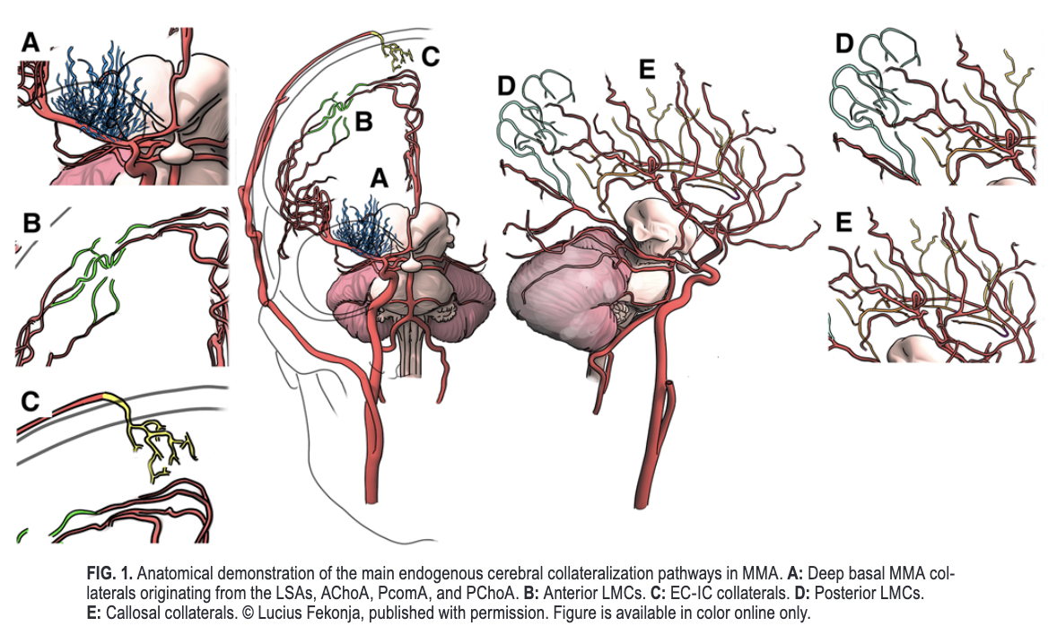 TheJNS's tweet photo. #OnlineFirst: Natural history of endogenous collateral vessels after revascularization surgery in patients with moyamoya angiopathy. 

https://t.co/BH3G1KT05B. https://t.co/sTirVLjY9Q