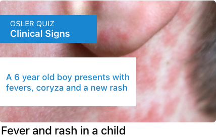 New quiz - child with fevers, coryza and rash

oslercommunity.com/s/preview/quiz…

#medtwitter #meded #tipsfornewdocs #CPDHome #CPDHomes #FOAMed #juniordoctors #juniordocs #emergencymedicine #emergencyphysician #generalpractitioner #Familymedicine