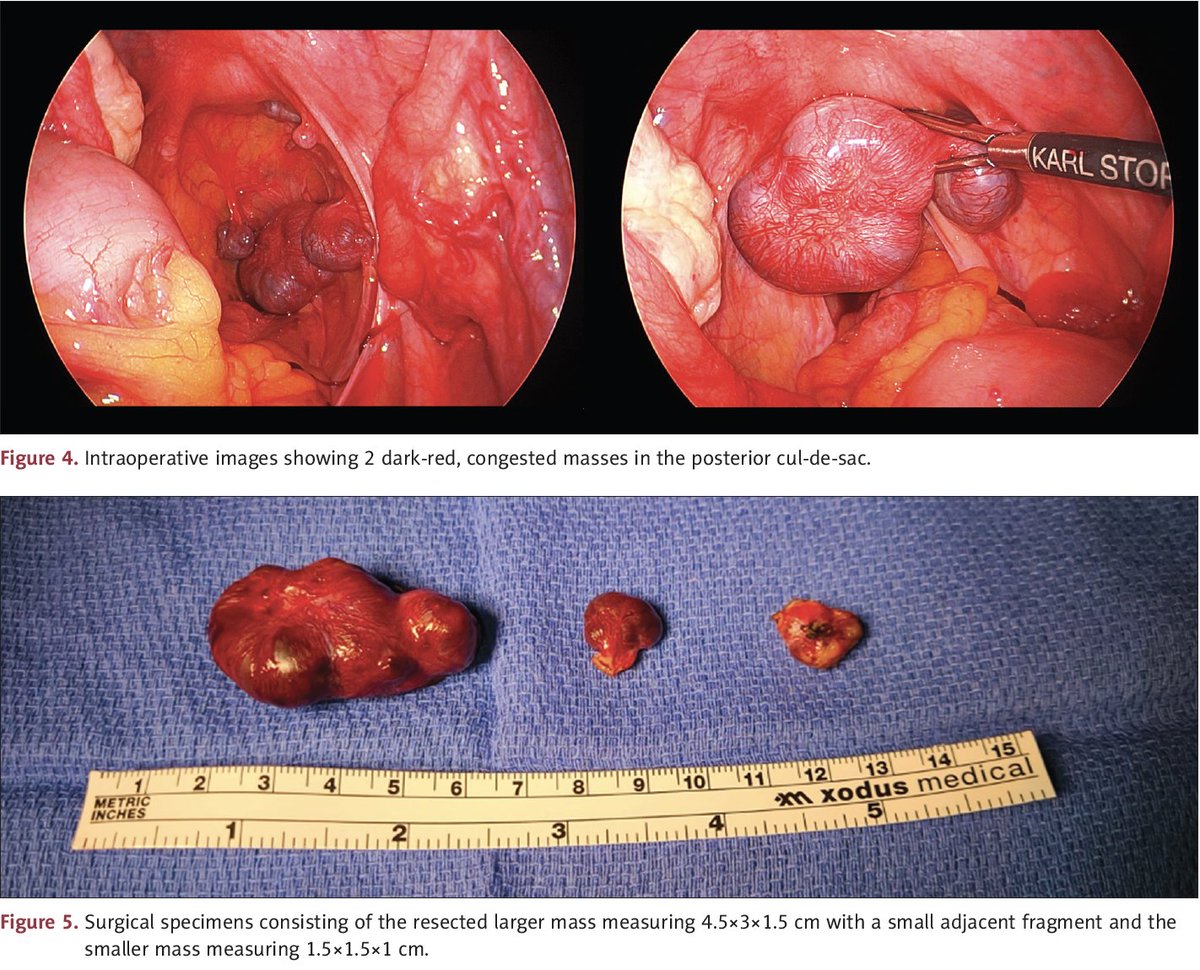 KAbdulJawadMD's tweet image. Excited to share our newly published case report in the @ACGCRJ on #splenosis in a post-trauma #splenectomy patient presenting with gynecologic complaints. Certainly a challenging diagnosis to keep in mind in this #trauma patient population. Link: doi.org/10.12659/AJCR.…