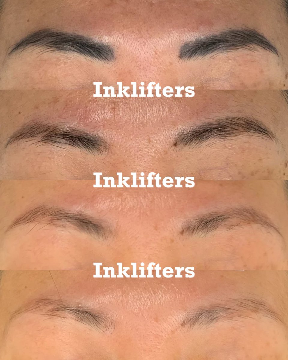 From brows to bare 😎🪄

Whether it’s old pigment, uneven shape, or simply time for a fresh start— our advanced laser technology helps fade unwanted ink safely and effectively.

Say goodbye to what no longer suits you and hello to a clean canvas 💃