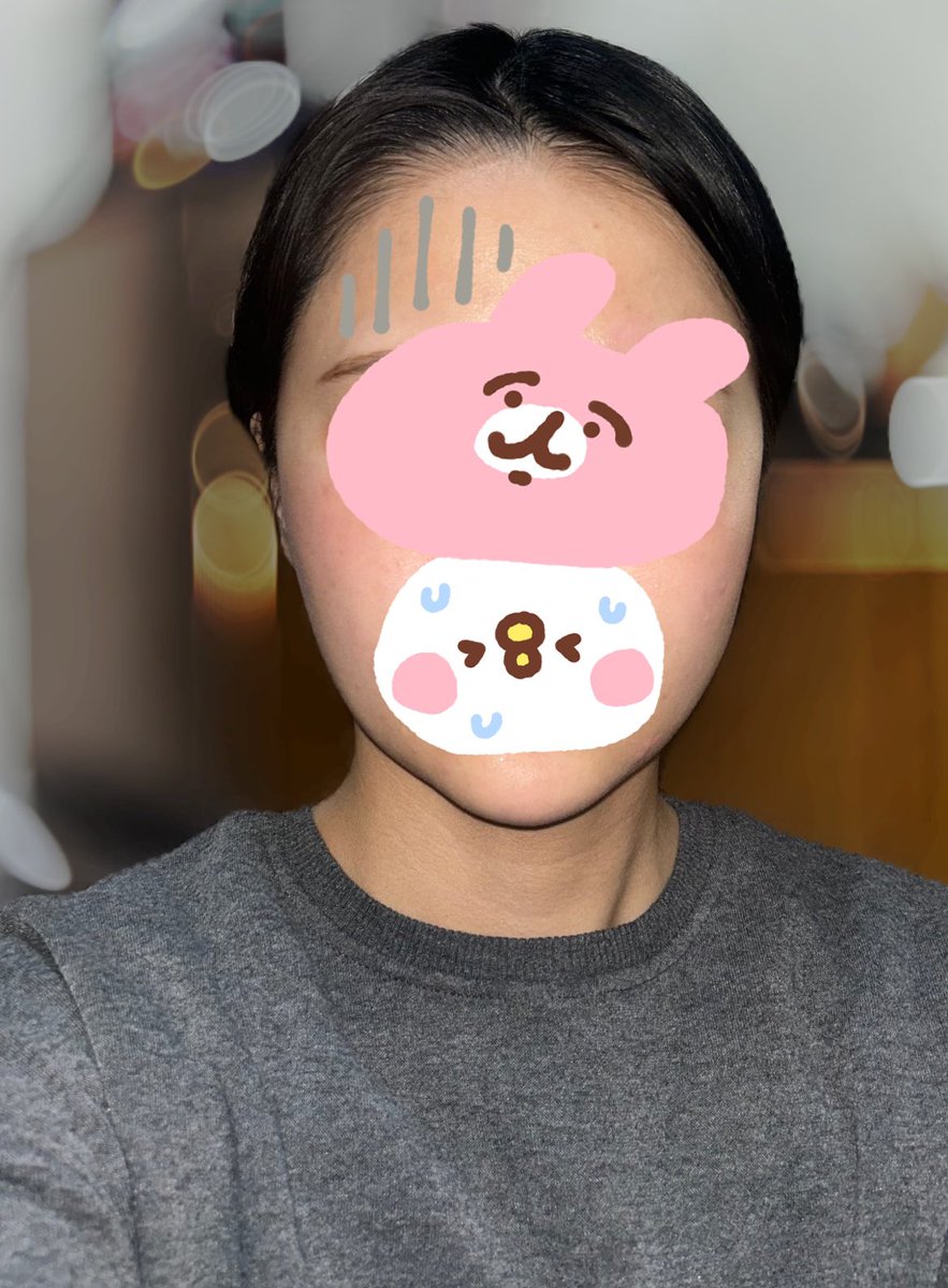 iadd77's tweet photo. 輪郭3点約DT11ヶ月目✨️2枚目の骨切り前、顔ボコボコすぎる笑😇 https://t.co/5aD91MNfc7