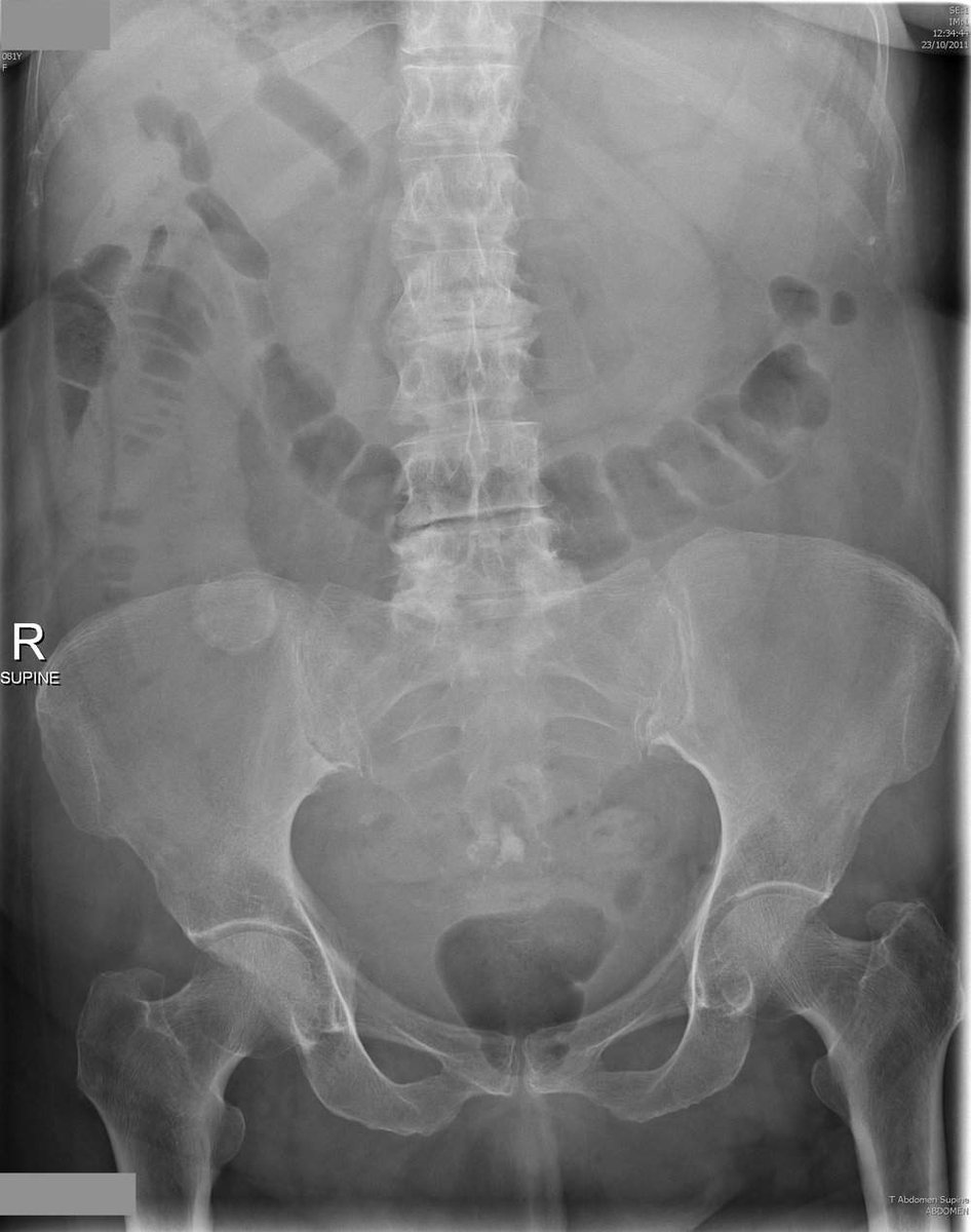 A 76 year old woman presents with severe abdominal pain, distention and vomiting for several days.   She looks unwell.

A supine abdominal X-ray is shown here

Describe the findings

oslercommunity.com/s/preview/quiz…

#CPDHome #CPDHomes #tipsfornewdocs #juniordoctors #meded #medtwitter