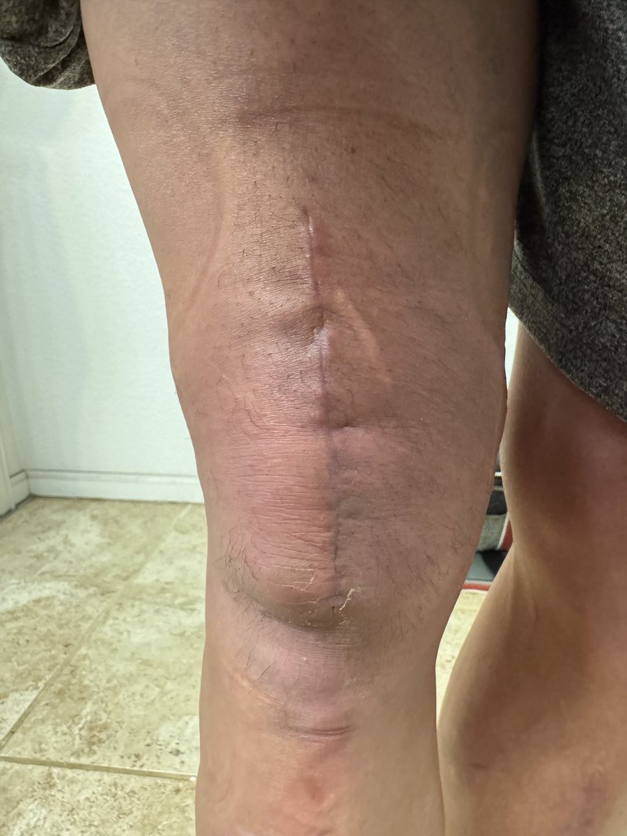 Nickybones1's tweet photo. One month post op. Doc says I’m ahead of schedule. I credit all the peptides and other gear along with Wolverine genetics. https://t.co/iD7rQ35obG