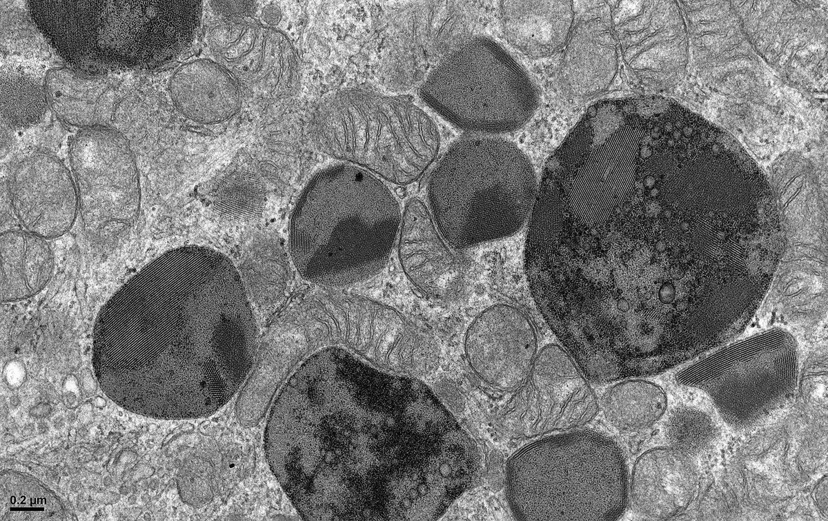 JohnBrealey's tweet photo. #electronmicroscopy Renal tx bx from a child w renal dysplasia as native disease. Any thoughts on these structures in tubules - ? lipofuscin, ? peroxisomes, ? a drug reaction. It’s the structures w periodicity that interest me. Human peroxisomes typically lack a crystalloid core https://t.co/zg6MDNygM4