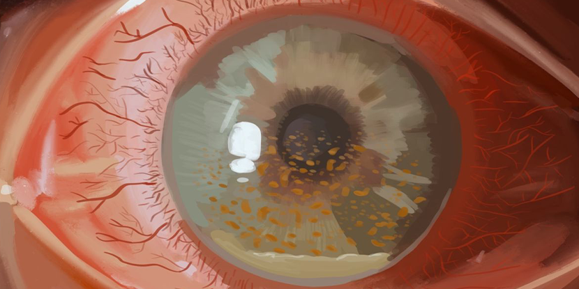 CMV anterior #uveitis can be difficult to diagnose. Clinical features include elevated #IOP, AC inflammation, iris atrophy, endotheliitis and, circinate keratic precipitates (KPs) or KP corrals.  #aao #ophthalmology ow.ly/HUZJ50VrNvL