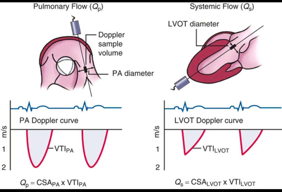 Doppler Shunt Ratio (Qp/Qs): Explained

Qp/Qs is the ratio of pulmonary (Qp) to systemic (Qs) blood flow, measured noninvasively using Doppler echocardiography. It's crucial for assessing the severity of left-to-right cardiac shunts (e.g., ASD, VSD, PDA).

How it's calculated:

-