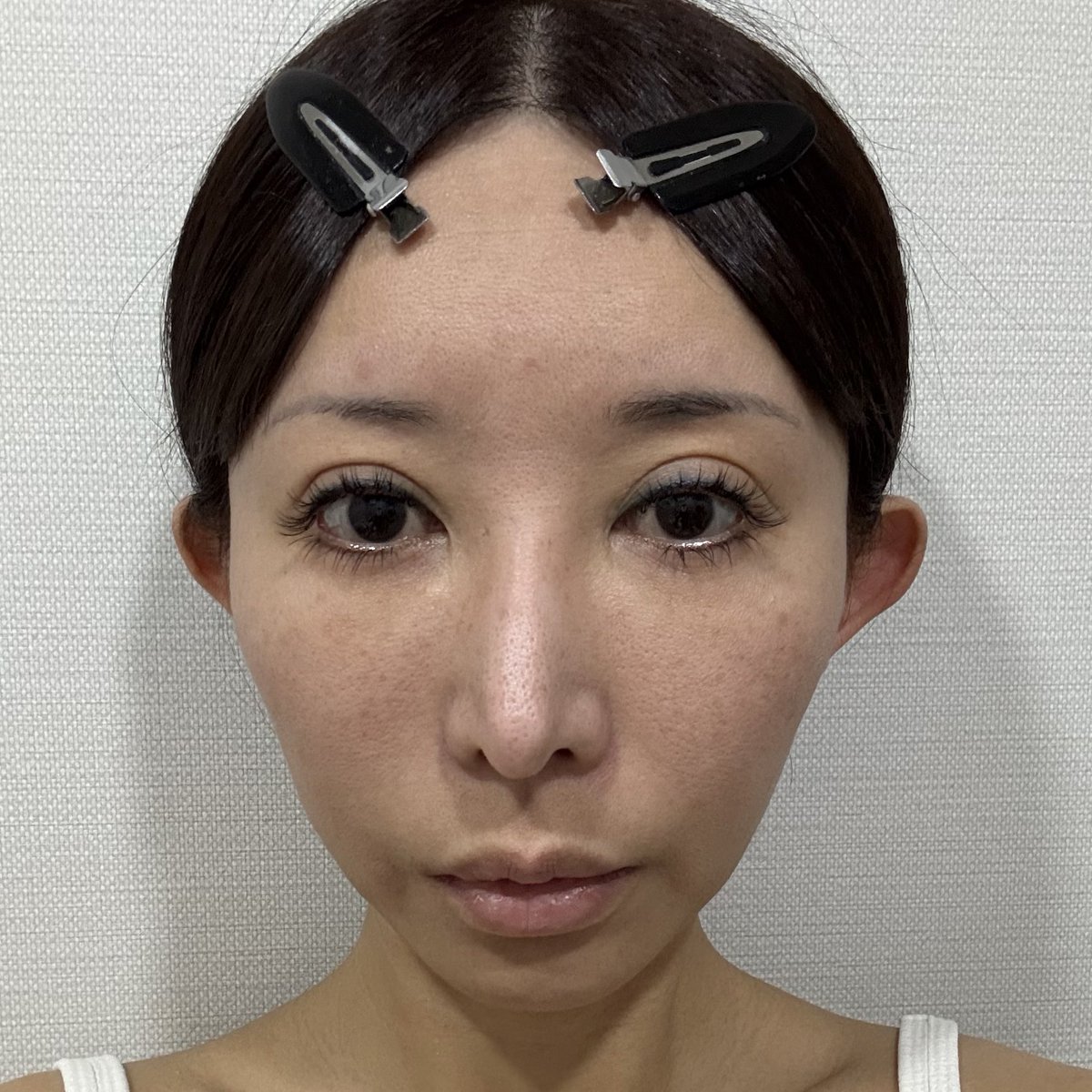 an20230422's tweet photo. 【手術直後】
5~6時間の手術時間でした！眼輪筋の切除もしたので片目が開かなくて辛いですが、生活は普通にできます！

術後の痛みは軽くある程度でした♪

バンドの圧迫で腫れが集中して爆発しそう泣

#セミン整形外科 #整形垢 #韓国整形 
#切開リフト #フェイスリフト

@seminpsjapan https://t.co/VU8WZOEdy1