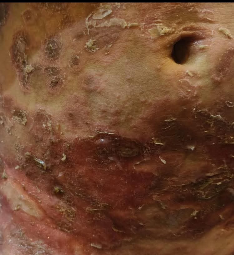 😭STOP URGENLY 😭
 
The infection spread throughout
 Nimir's baby girls entire body Namir needs to get her kids out of g@za please help them ASAP
THEIR TREATMENT IS NOT WORKING AND THE WEATHER IS MAKING IT WORSE
 
HELP ME GET TREATMENT
gofundme.com/f/help-muhamma…
#BB26