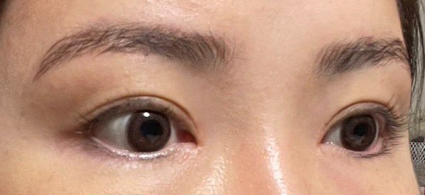 plastic_body's tweet photo. ハイエンド整形外科で目頭切開と目上切開をして1カ月経過しました✨
＠highendpsj https://t.co/6i4qMLSIfj