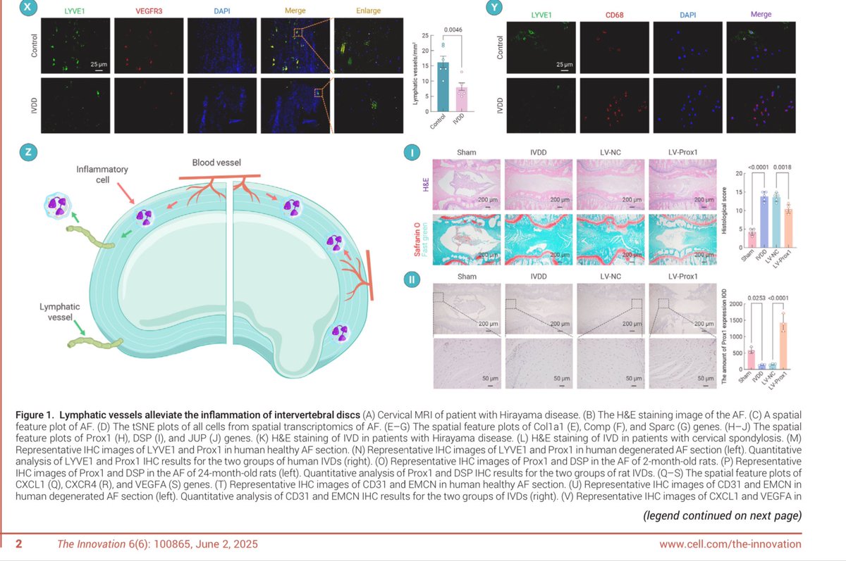 Revealing the presence of lymphatic vessels within intervertebral discs: Novel insights into disc degeneration

pdf.sciencedirectassets.com/777800/AIP/1-s…
Interesting new findings of lymph vessels in IVDs