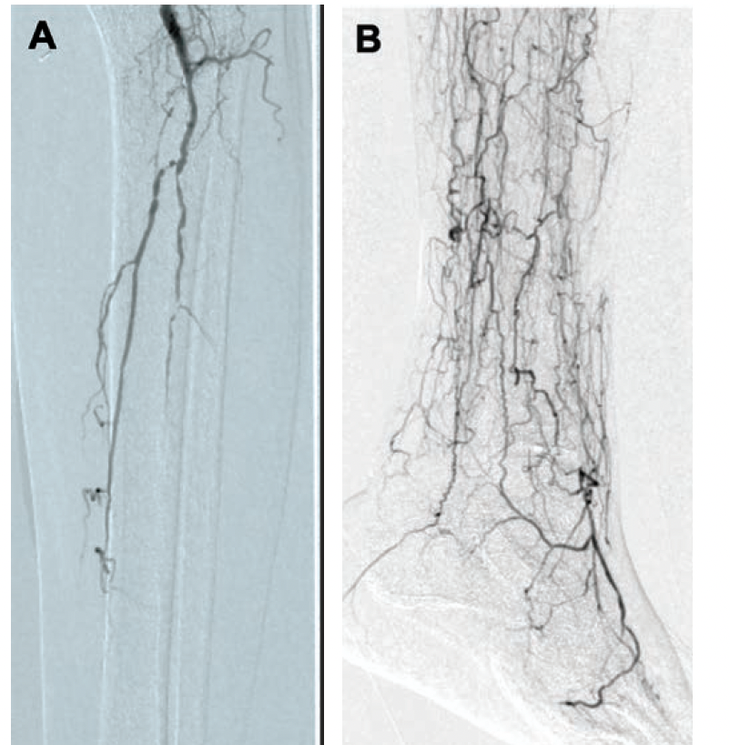 Journal of Critical Limb Ischemia tweet media