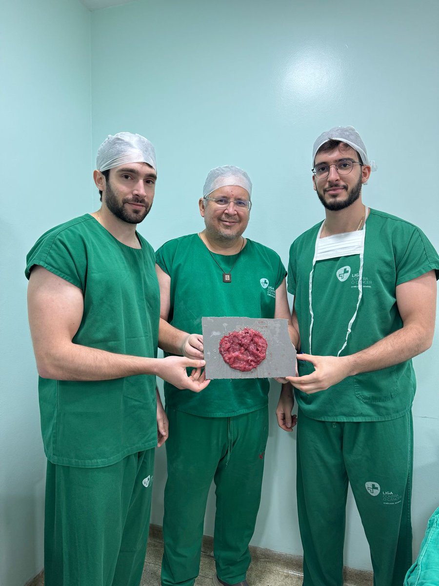 LST with intramucosal adenocarcinoma of the rectosigmoid junction, with an 18 cm extension. Treated with ESD.