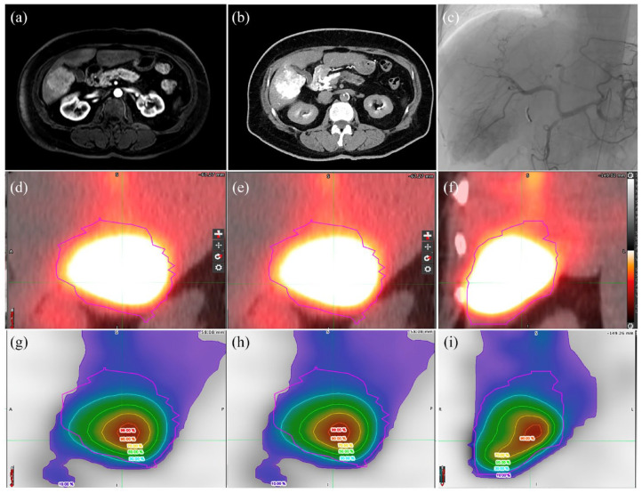 ETF_IRtrainees's tweet photo. Interesting read to prepare for #ECIO2025! 📖

Click on the link below and read more about new options for radioembolization:
https://t.co/UmtXliETOf https://t.co/ocs2EY5XlP