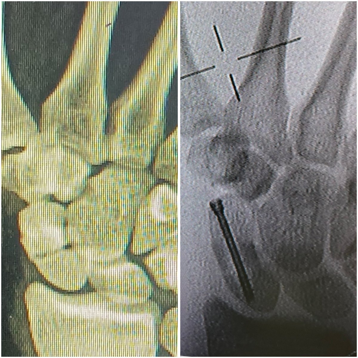 drsonipavan's tweet photo. Another one 👌 learning points 1. I will always remove some of the trapezium to get a better screw trajectory 2. I will always arrange a better drill for these cases, or invest in getting one for myself. Hand cases are unnecessarily difficult with the general orthopaedic drills. https://t.co/cMNiDxlJYu