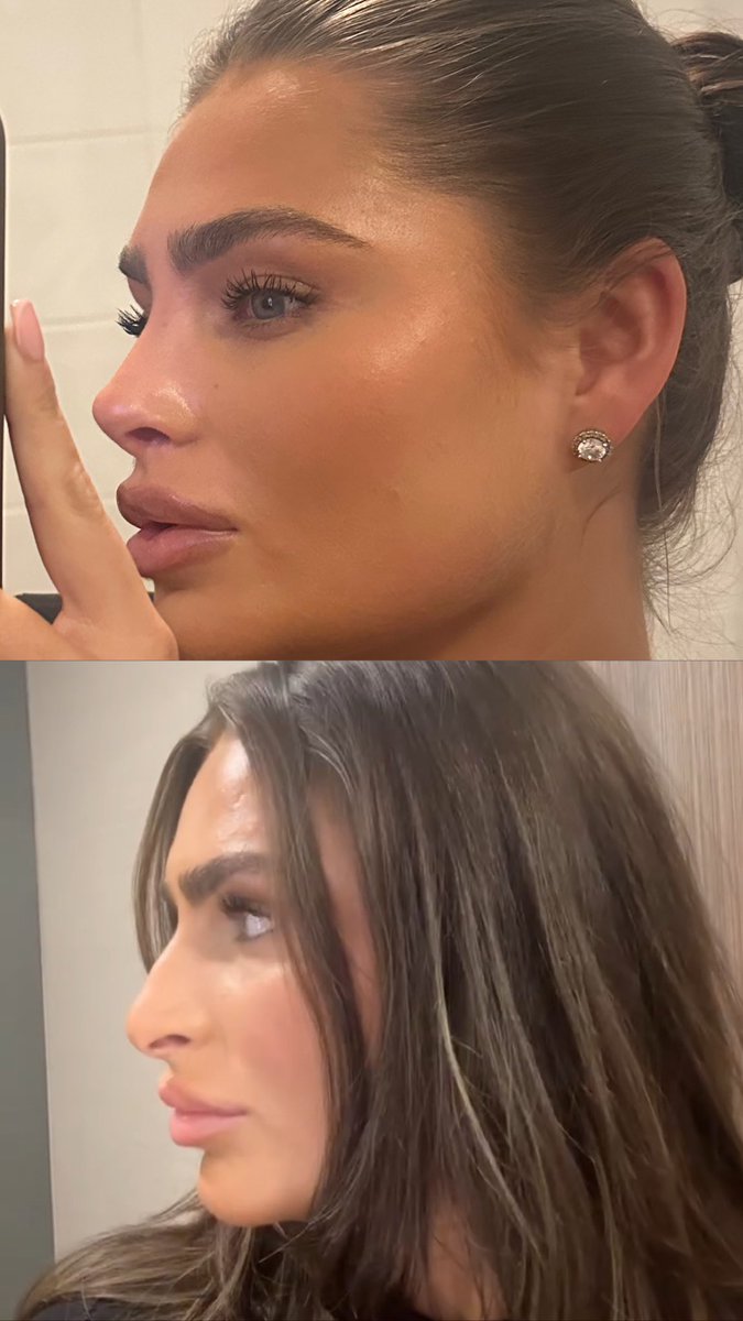 BVatsaloo's tweet photo. Omg the difference!!!! 👃 #rhinoplasty https://t.co/TtCZWaNAJ5