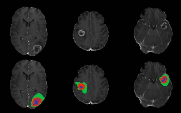 UCL Brain Sciences (@uclbrainscience) on Twitter photo Dr <a href="/JKRuffles/">Dr James K Ruffle</a> and the wider team at the High-Dimensional Neurology group at @UCLiON are transforming brain cancer care with AI-based tools that can analyse brain scans within seconds.
We spoke to Dr Ruffle about their progress: buff.ly/BB7Zsug Dr <a href="/JKRuffles/">Dr James K Ruffle</a> and the wider team at the High-Dimensional Neurology group at @UCLiON are transforming brain cancer care with AI-based tools that can analyse brain scans within seconds.
We spoke to Dr Ruffle about their progress: buff.ly/BB7Zsug