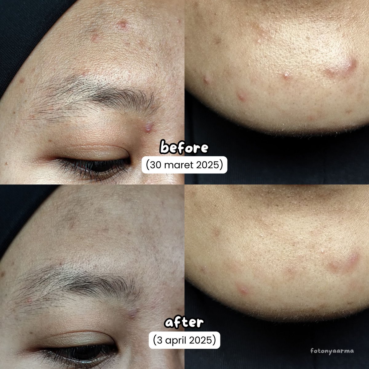 naneundallaaa's tweet photo. RACUN LEBAH TAPI BISA REDAIN JERAWAT DALAM 3 HARI!!!
Real banget sih ini progresnya, padahal baru 3 harian pakai @Adara_ID Bee Clear “Extra Formula” ternyata jerawatku udah mereda. Beneran ngaruh produk lokal yang satu ini.
#racuninskincare #LetsBeeClear https://t.co/o2dWPD0qLh
