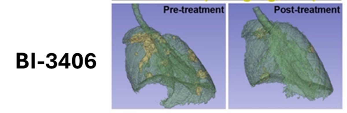 🔴NEWS | 

"SOS1 identificada como nueva diana terapéutica en adenocarcinoma de pulmón"

Noticia completa➡️ibis-sevilla.es/es/noticias/in…