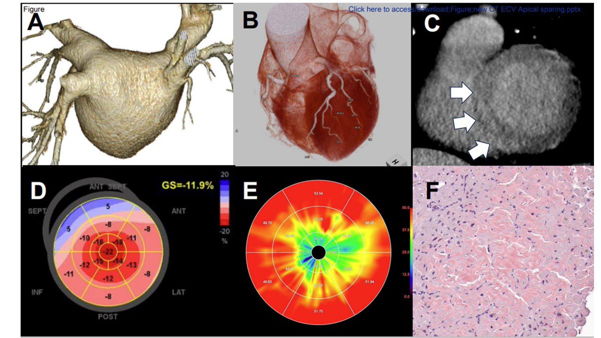 #EHJCVI 🔥Hot off the press 🔥 Apical Sparing of ECV Abnormality in Cardiac #Amyloidosis on Computed Tomography #YesCCT ➡️ academic.oup.com/ehjcimaging/ad… <a href="/ESC_Journals/">European Society of Cardiology Journals</a> <a href="/EACVIPresident/">EACVI President</a> <a href="/ShehabAnwer/">Shehab Anwer, MD</a> <a href="/EZancanaroMD/">Edoardo Zancanaro MD</a> <a href="/AnnaKateBarton/">Anna Kate Barton</a> <a href="/saramoscatelli7/">Sara Moscatelli</a> <a href="/BenekiEirini/">Eirini Beneki</a> <a href="/VikashJaiswalMD/">Vikash Jaiswal</a> <a href="/OxMarchenko/">Oksana Marchenko</a>