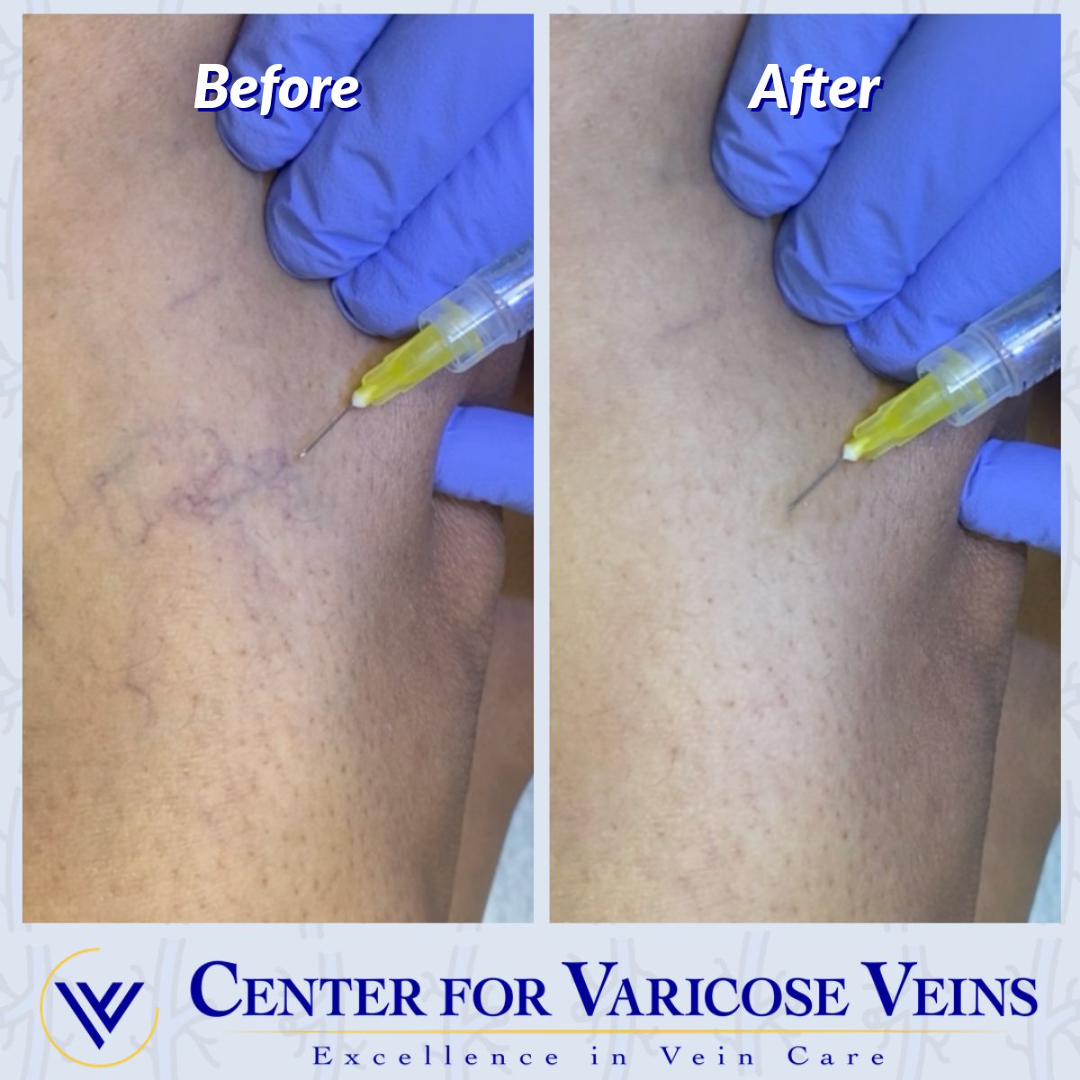 CenterMadan's tweet photo. You might need sclerotherapy if you have varicose veins or spider veins, which are typically caused by a circulatory problem called chronic venous insufficiency (CVI). To learn more visit:  https://t.co/Tykz6iaCMG⁠
⁠
#SpiderVeins #VaricoseVeins 
⁠
https://t.co/VWVUKzcuH6 https://t.co/acqk3EHAmO