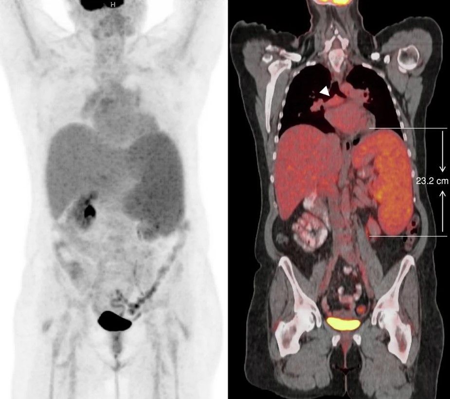 ESRJournals's tweet photo. #EuraSpotlight on Lymphoma Imaging
🎯 How do we image lymphoma? The latest #ESREssentials article provides key recommendations on when to use PET/CT vs. CT, biopsy considerations, and how to apply the Deauville score.

🔗 Full article here: https://t.co/xwPm6e5Qsw
(Doris Leithner et al.)

⬇️ Key insights:

1️⃣ FDG-PET/CT for most lymphomas
✅ Hodgkin lymphoma
✅ Aggressive NHLs (e.g., diffuse large B-cell lymphoma)
✅ Many indolent NHLs (e.g., follicular lymphoma)

2️⃣ CT for select cases
📌 SLL/CLL and some non-FDG-avid NHLs should undergo CT instead of PET/CT, unless there’s suspicion of transformation to high-grade lymphoma.

3️⃣ Bone marrow biopsy? It depends!
📌 Hodgkin lymphoma: PET/CT can rule out bone marrow involvement.
📌 Other lymphomas: Biopsy may still be required for confirmation.

4️⃣ Assessing treatment response?
📌 Use the Deauville 5-point scale (5-PS) for FDG-avid lymphomas:
✅ Uptake ≤ liver uptake = complete response
📌 For non-FDG-avid lymphomas, CT is used to monitor lesion size changes.

💭 How do you approach lymphoma imaging? Let’s discuss in the comments! 👇

#EuraSpotlight #Lymphoma #PETCT #OncologicImaging #Radiology #CancerCare
