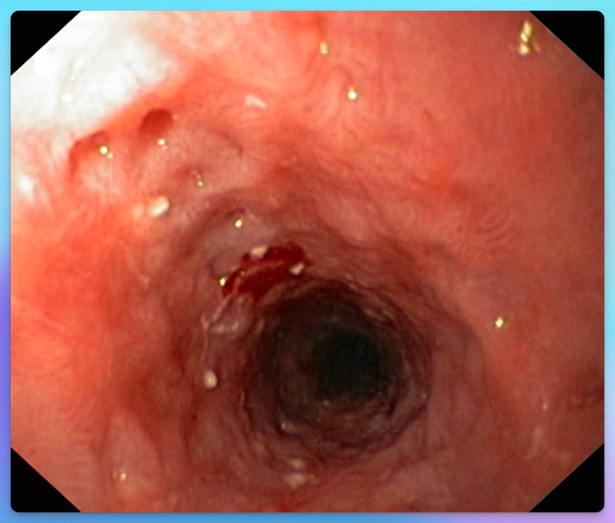 EndoCollab™ | GI Endoscopy Community tweet media
